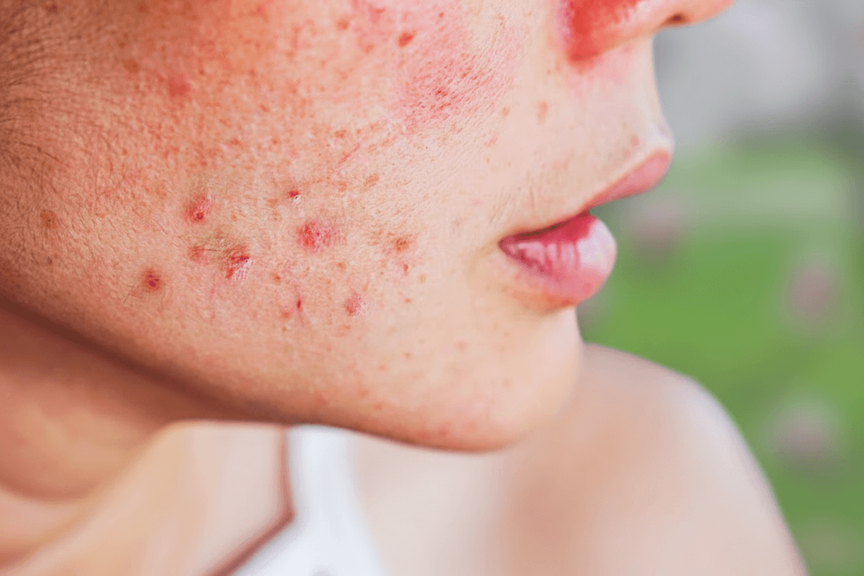 Acne Prone Skin